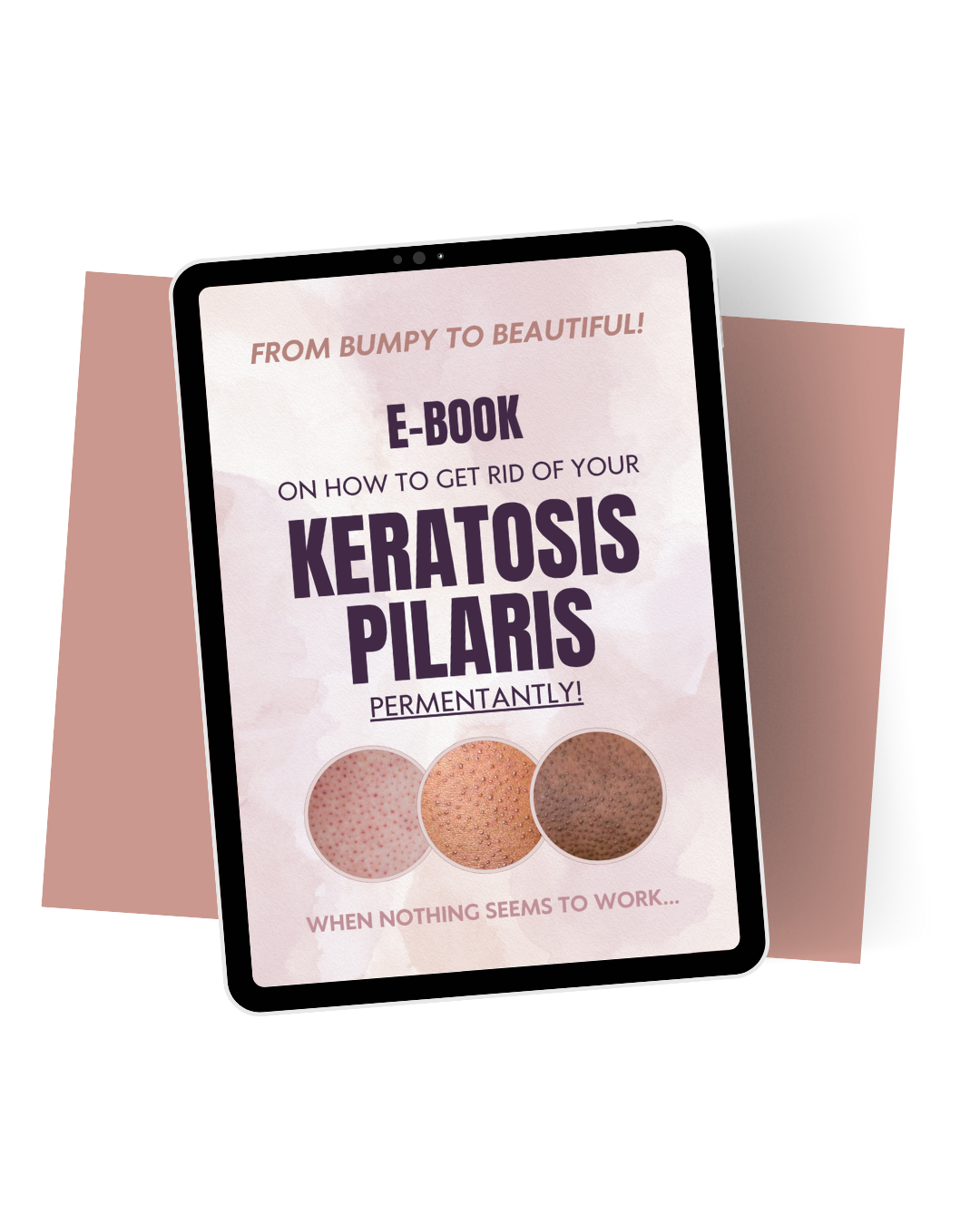 From Bumpy to Beautiful: How to Get Rid of Your Keratosis Pilaris Permanently!